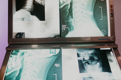 A lab vignette included X-rays of necks embedded with disks like the ones seen in the show.